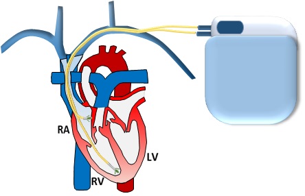 Pacemaker-ICD implantation (permanent)